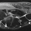 Solitary Bone Plasmacytoma of Left Wrist Joint – A Case Report