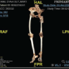 Managing Periprosthetic Fracture of the Proximal Femur Using Total Hip Arthroplasty in a Patient with Sequelae of Poliomyelitis: Case Report and Literature Review