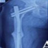 Augmentation Plating with Intramedullary Nailing for Aseptic Long Bone Non-union: A Prospective Observational Study of Clinical, Radiological, and Functional Outcomes