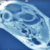 Tuberculosis of the Elbow in a Chronic Kidney Disease Patient with Arteriovenous Fistula: A Case Report