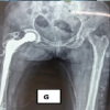 Hydatid Disease Masquerading as Infected Non-Union of Subtrochanteric Femur: A Rare Case Report