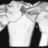Functional Outcomes and Surgical Utility of the Modified Schatzker Four-column Concept in Proximal Tibial Plateau Fractures: A Prospective Observational Study