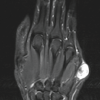Bizarre Parosteal Osteochondromatous Proliferation: A Case Series and Literature Review