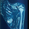 Surgical Excision of a Rare Ventral Scapular Osteochondroma using the Prone “Chicken-Wing” Position: A Case Report