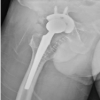 Metallosis Following Total Hip Arthroplasty: A Case Report