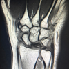 Kienbock’s Disease in a Young Female without Classical Risk Factors: A Case Report with 1-year Functional Outcome Following Proximal Row Carpectomy