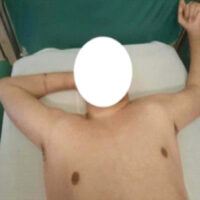 Figure 1: Photograph showing patient with bilateral luxatio erecta humeri.
