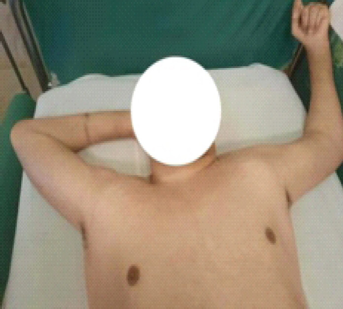 Figure 1: Photograph showing patient with bilateral luxatio erecta humeri.
