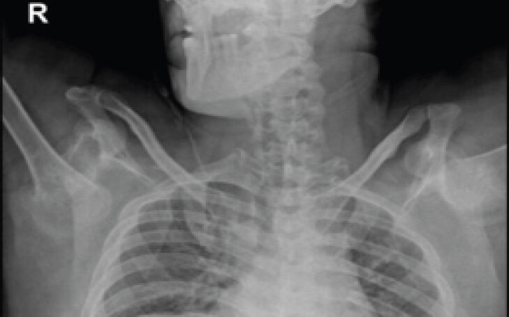 Figure 2: Anteroposterior radiograph of both shoulder joints, showing bilateral chronic neglected luxatio erecta humeri.