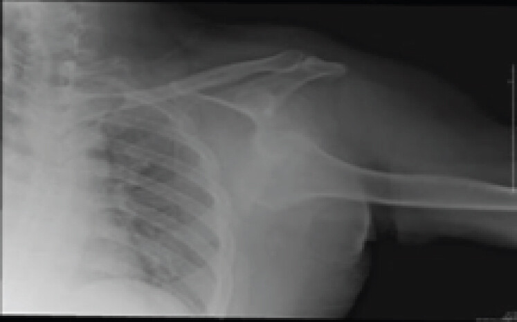 Figure 3: Coronal computed tomography scan of the left shoulder, showing chronic neglected luxatio erecta humeri.