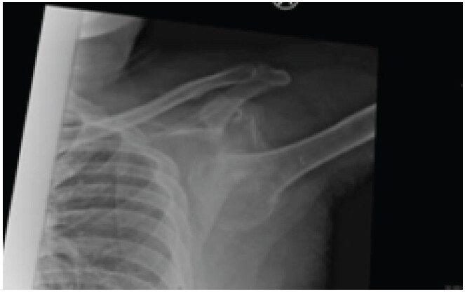 Figure 4: Coronal computed tomography scan of the right shoulder, showing chronic neglected luxatio erecta humeri.