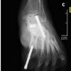 The Missing Navicular: Bilateral Navicular Agenesis Presenting as Adult-acquired Flatfoot with Subtalar Arthritis: A Case Report