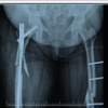 Fracture Fixation Sequencing in Polyskeletal Trauma: Clinical Experience from a Five-Patient Retrospective Series