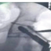 Beyond Pipkin IV: Management of Femoral Head-neck Fracture-dislocation with Posterior Acetabular Wall and Peritrochanteric Fracture in an Adolescent Using a Modified Kocher-Langenbeck Approach