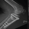 Pes Anserinus and Superficial Medial Collateral Ligament Preserving High Tibial Osteotomy Combined with Arthroscopic Medial Meniscus Root Repair for Medial Compartment Osteoarthritis with Varus Deformity: A Prospective Case Series of 20 Patients