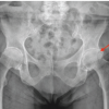 Posterior Acetabular Wall Fracture Mimicking a Subcapital Femoral Neck Fracture on Plain Radiographs: A Diagnostic Pitfall and the Role of Intraoperative Fluoroscopy: A Case Report