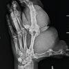 Adult Presentation of Congenital Macrodactyly of the Hand Managed with Debulking and Amputation of a Digit: Report of a Rare Case