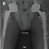 Bone Morphogenetic Proteins-2–Augmented Acetabular Bone Stock Restoration During Two-stage Revision for Periprosthetic Joint Infection: A Case Report