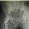 Enhanced Stability in an Unstable Femoral Neck Fracture Using the Femoral Neck System with Two Additional Cannulated Cancellous Screws: A Case Report