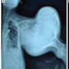Severe Deforming Ollier Disease with a Giant Proximal Humeral Benign Chondroid Lesion in an Adolescent Male: Case Report