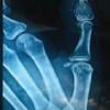 Thumb Distal Phalanx Enchondroma: Expanding the Surgical Corridor Through a Modified Volar Lateral Technique – A Case Report