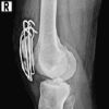 A Prospective Study of Comminuted Patellar Fractures Treated with Different Fixation Modalities: Functional Outcomes and Complications