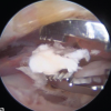 Isolated Calcific Deposition in the Subacromial Bursa: A Rare Case Report and Arthroscopic Management