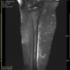 Not All Red Flags Indicate Malignancy: A Case Report of a Benign Lipoma Mimicking Soft-tissue Sarcoma