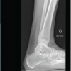Malleolar Stress Fracture as the First Manifestation of Undiagnosed Crohn’s Disease: A Case Report
