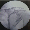 Varied Reduction and Fixation Modalities for Scapula Fractures: A Case Series
