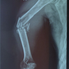 Brown’s Tumor Presenting as a Pathological Humerus Fracture: A Rare Diagnostic Pitfall