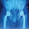 A Rare Case of Salmonella Typhimurium Prosthetic Joint Infection in Total Hip Arthroplasty in a Young Patient with Long-term Corticosteroid Therapy