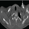 Bilateral Non-Displaced Clavicle Fractures: A Very Rare Case Report