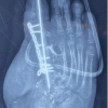 Beyond the Biopsy: Macrodystrophia Lipomatosa Unmasked After False Osteochondroma Diagnosis