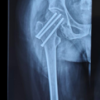 Platelet-Rich Plasma Augmentation of Osteosynthesis in Femoral Neck Fractures: A Prospective Comparative Study Demonstrating Accelerated Union and Improved Function