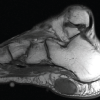 Sclerosing Atypical Lipomatous Tumor with Myxomatous Features Presenting in the Plantar Heel: A Case Report