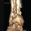 Management of Chronic Osteomyelitis Bone Defect Titanium Cage Combined with the Masquelet Technique: A Case Report