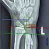 Outcomes of Surgical Treatment for Masada Type lVa Forearm Deformity in Children with Multiple Hereditary Exostosis: A Case Series
