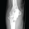 The “Terrible Tetrad” of the Elbow: A Case Series of Two Patients with a Rare Quadruple-Component Injury and a Proposed New Classification Term