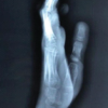 Hang Fire – Acute Crush Injury of Fingers – Till Appropriate Intercede – A Case Report