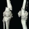 Megaprosthetic Total Knee Arthroplasty for Supracondylar Refracture in a Post-traumatic Osteoarthritic Knee: A Case Report