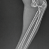 To Explore or Not? Conservatively Managed Brachial Artery Injury with Good Collateral Flow After Elbow Reduction: A Case Report