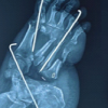 Limb Salvage in a Mangled Foot with Severe Midfoot Bone Loss: A Case Report and Review of Principles of Reconstruction
