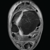 Pilon Fracture with Associated Achilles Tendon Rupture: Case Report and Review of the Literature