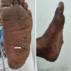 A Solitary Large Calcaneal Osteochondroma in a Skeletally Mature Patient: Case Report