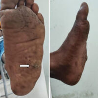Figure 1: Clinical lateral view showing protruding mass on the plantar and lateral aspect of the foot and hyperkeratosis at the apex of the swelling.