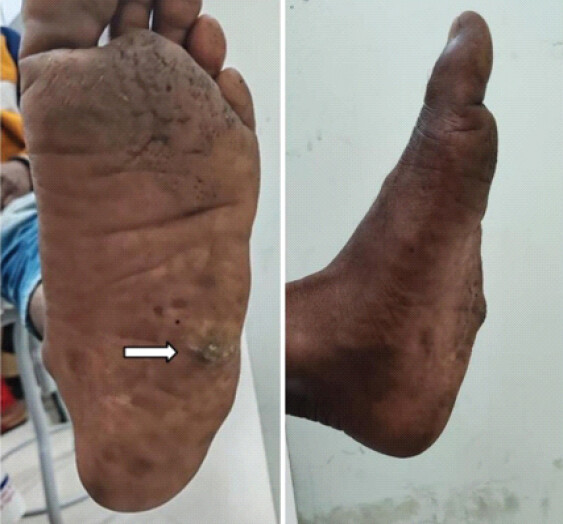 Figure 1: Clinical lateral view showing protruding mass on the plantar and lateral aspect of the foot and hyperkeratosis at the apex of the swelling.