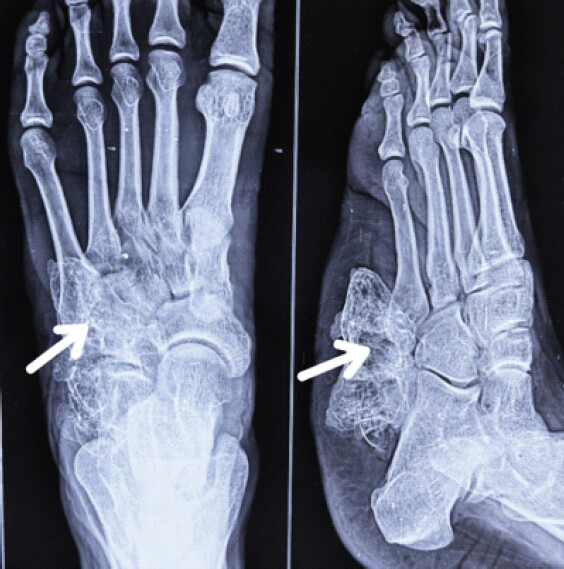 Figure 2: Radiographs (anteroposterior and lateral) showing a sessile bony lesion from the plantar and lateral aspect of the calcaneus.