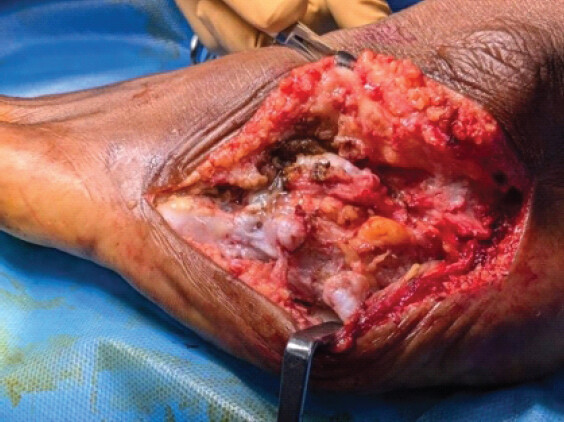 Figure 3: Intraoperative view after elevation of full-thickness flaps.