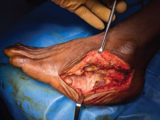 Figure 4: Post-excision cavity on calcaneus.